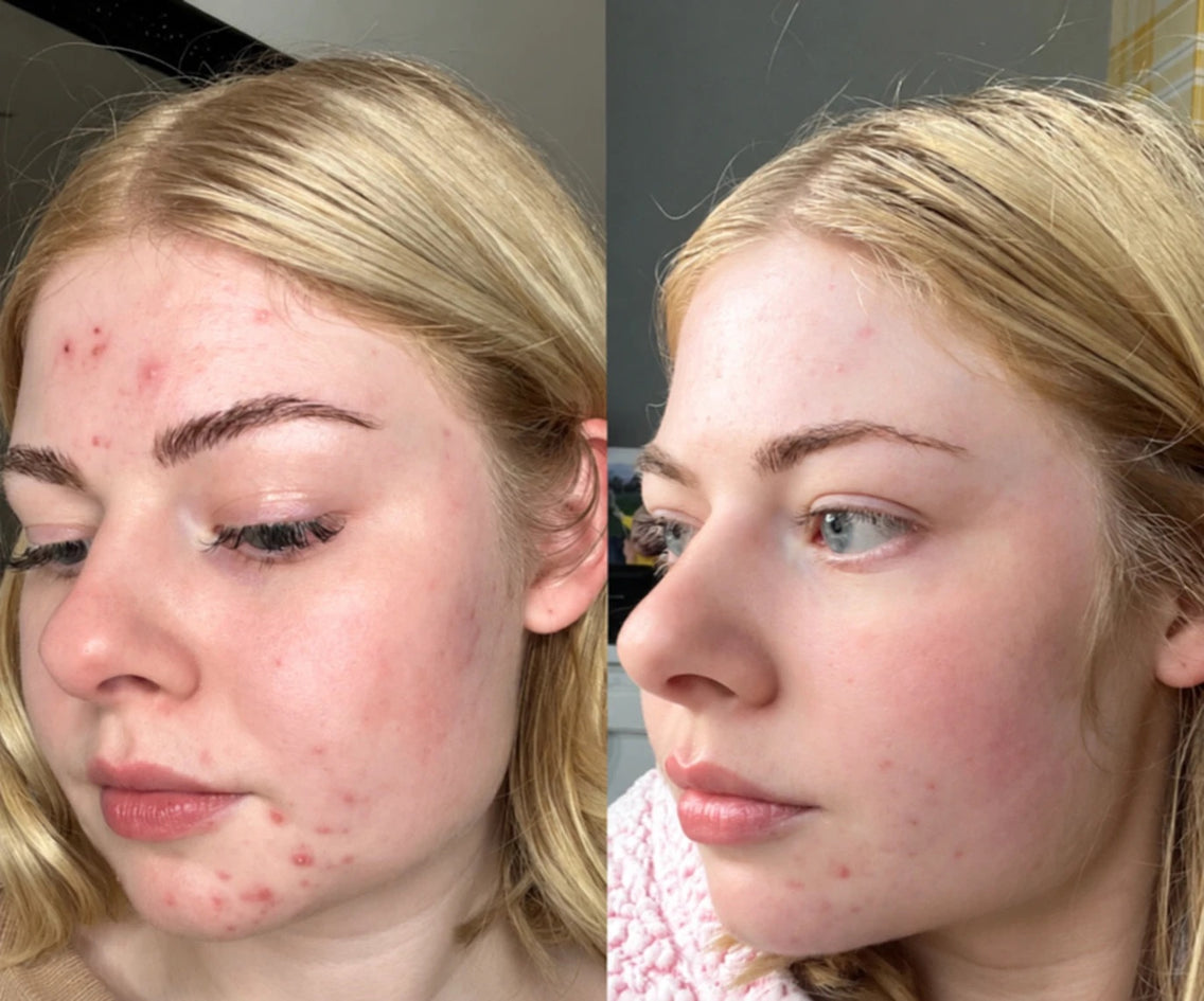 Example before and after of acne-prone skin