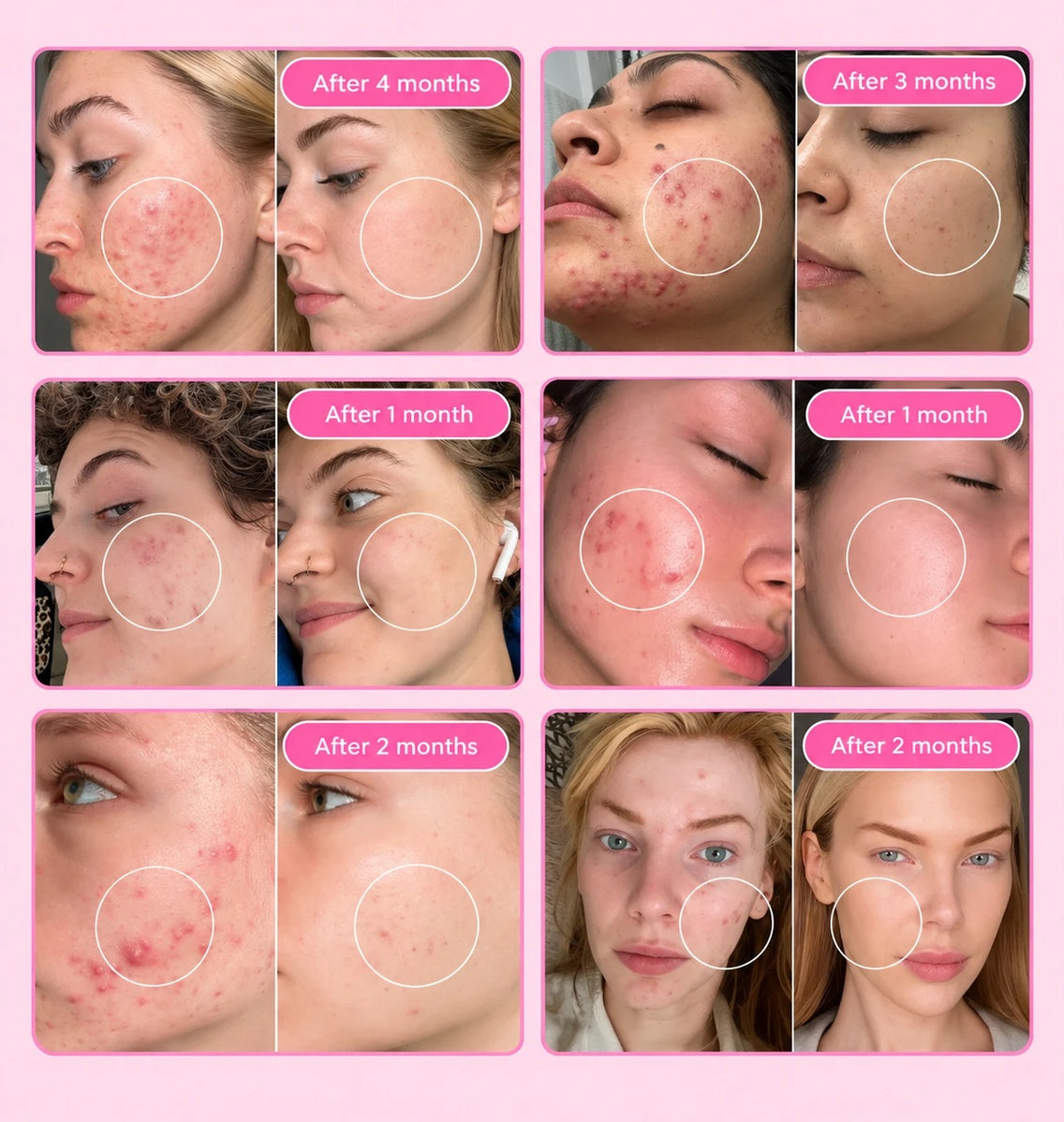Six before and after photos of acne-prone skin