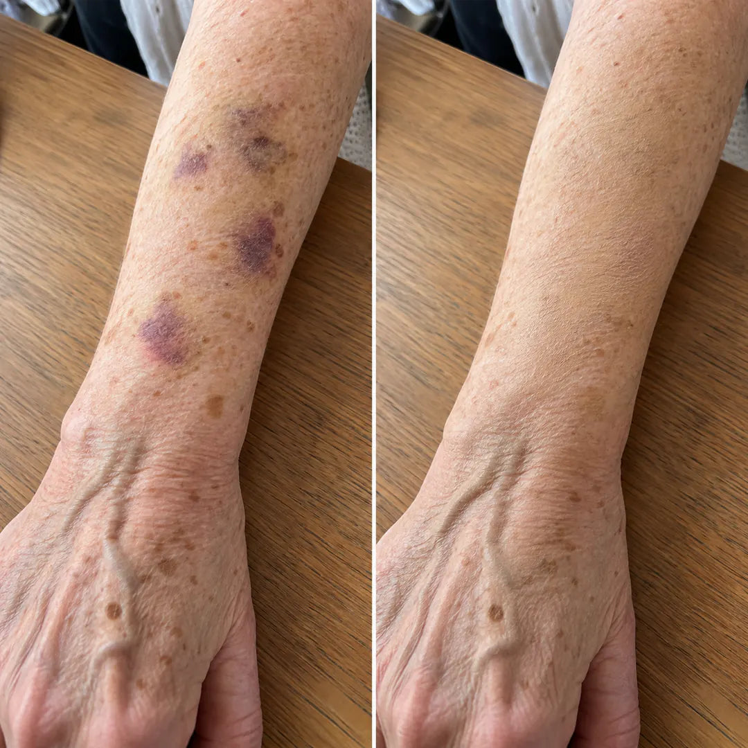 The same forearm before and after, purple marks covered