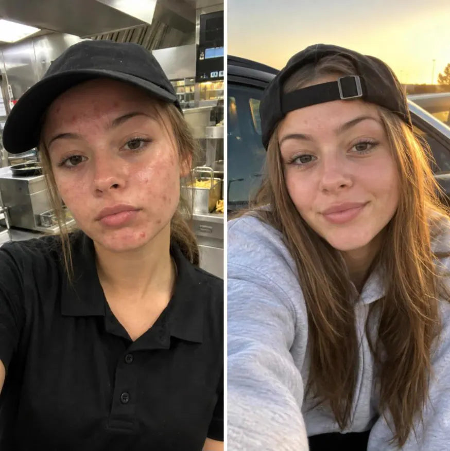 Before at the fryer with breakouts, and months later with clear skin, cap backwards