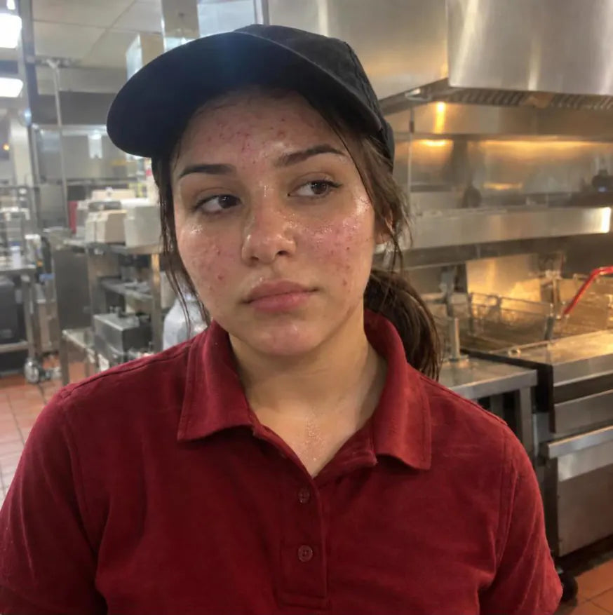 A teen girl in a fast-food uniform by the fryer, with breakouts on her forehead and cheeks